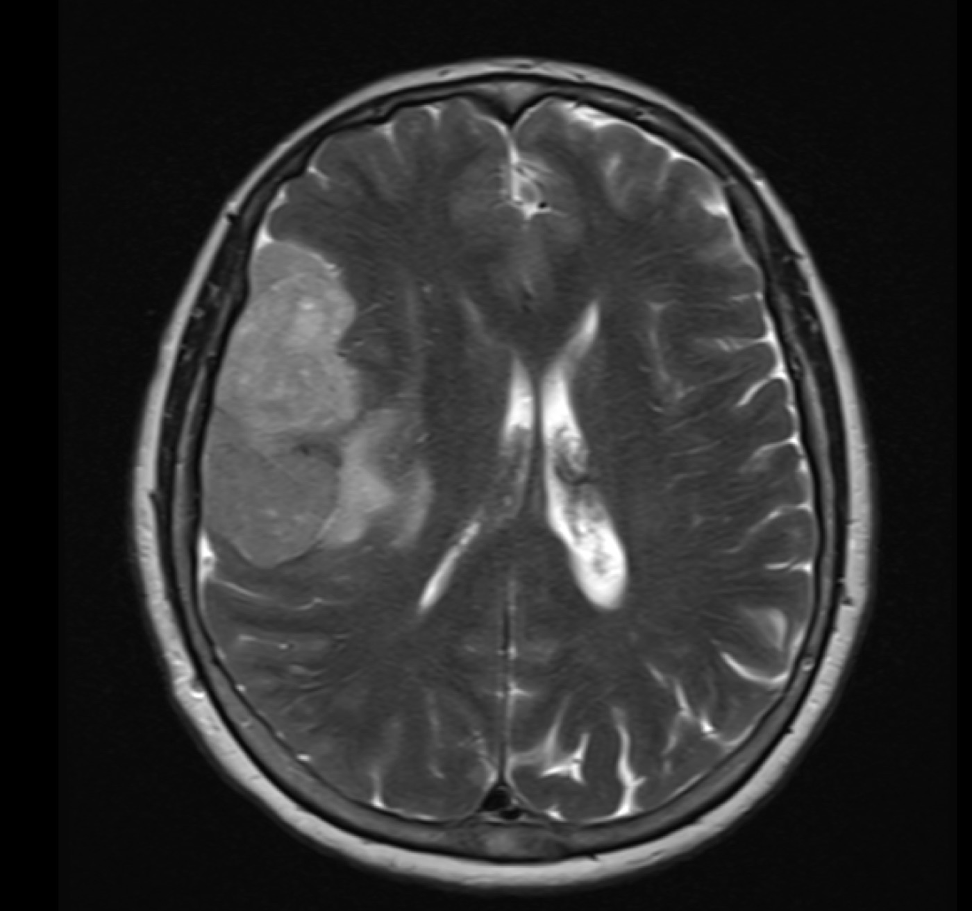 Risonanza magnetica di un meningioma parietale