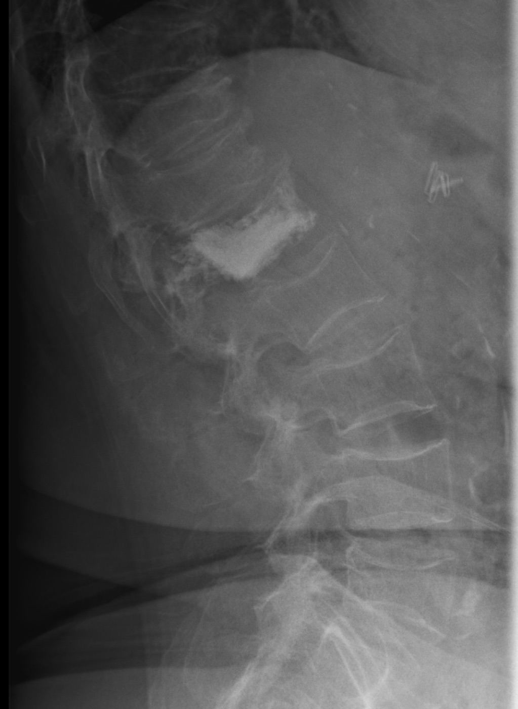 Radiografia dopo vertebroplastica percutanea